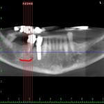 tac cone beam nervo 1_1