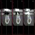 tac cone beam nervo 1_2